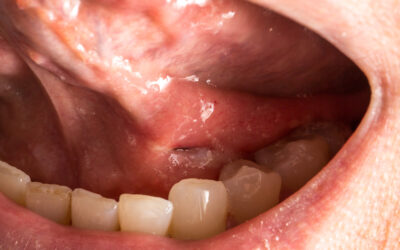 Por qué salen llagas en la boca: causas y tratamiento