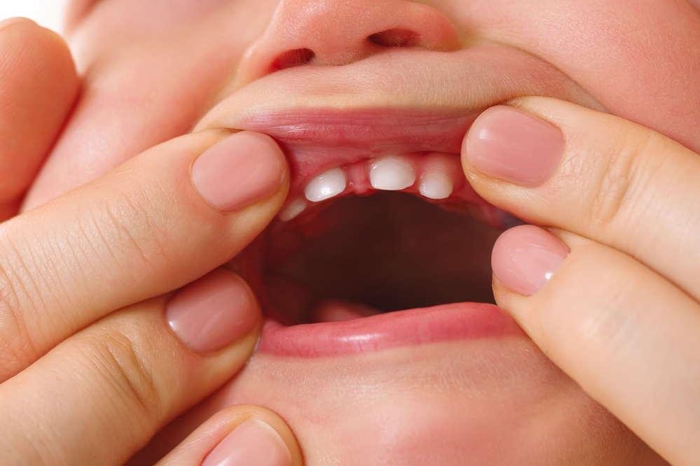 Qué Significa Realmente un Diastema