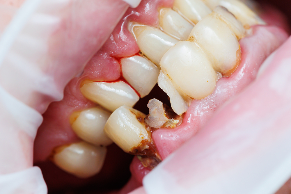 Síntomas De Una Caries Profunda: Señales De Alarma Urgentes 1 Qué es una Caries Profunda y Cómo se Desarrolla