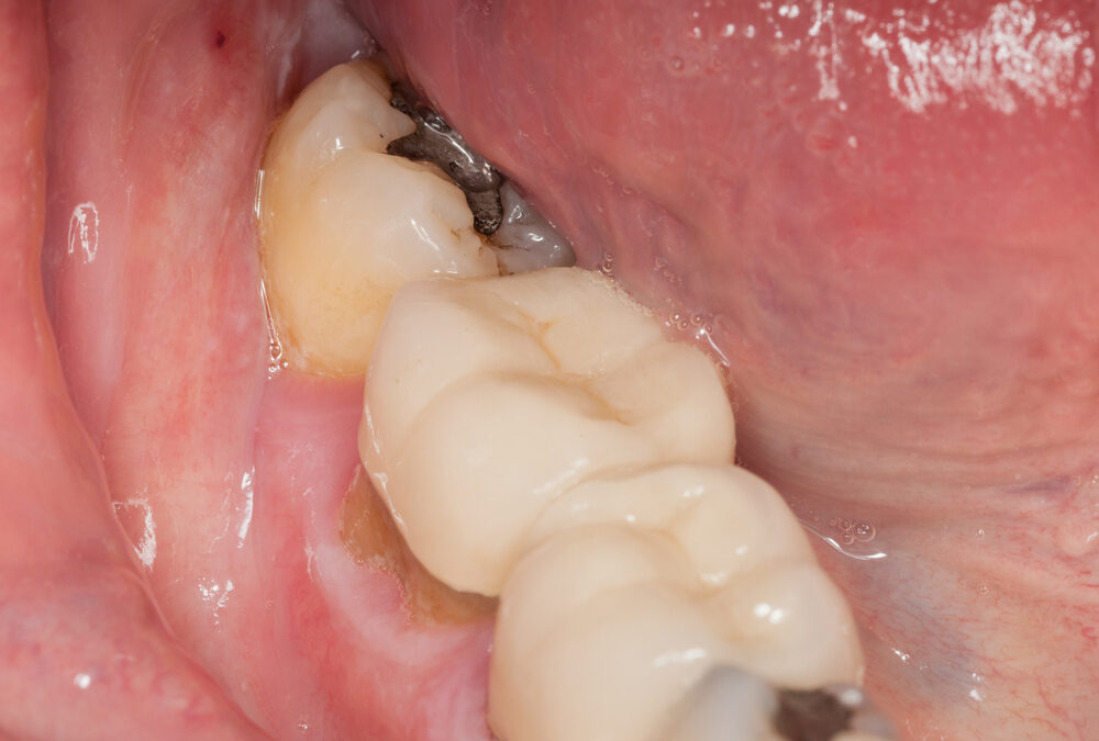 Síntomas de una Caries Profunda: Señales de Alarma Urgentes