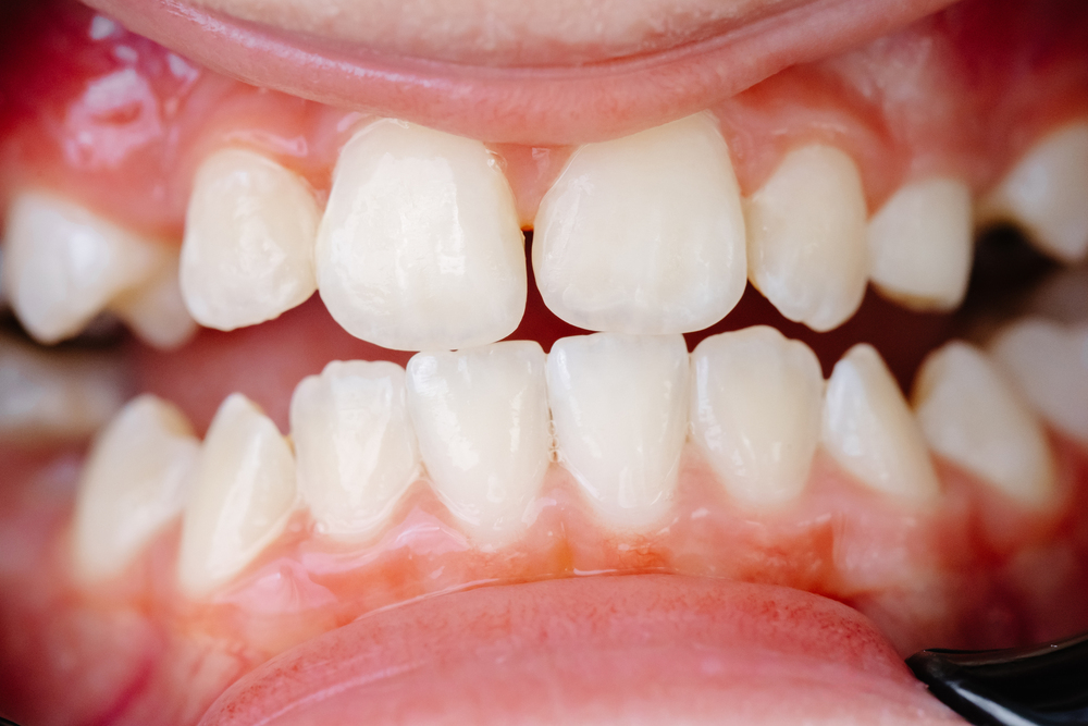 ¿Qué es la Maloclusión Dental