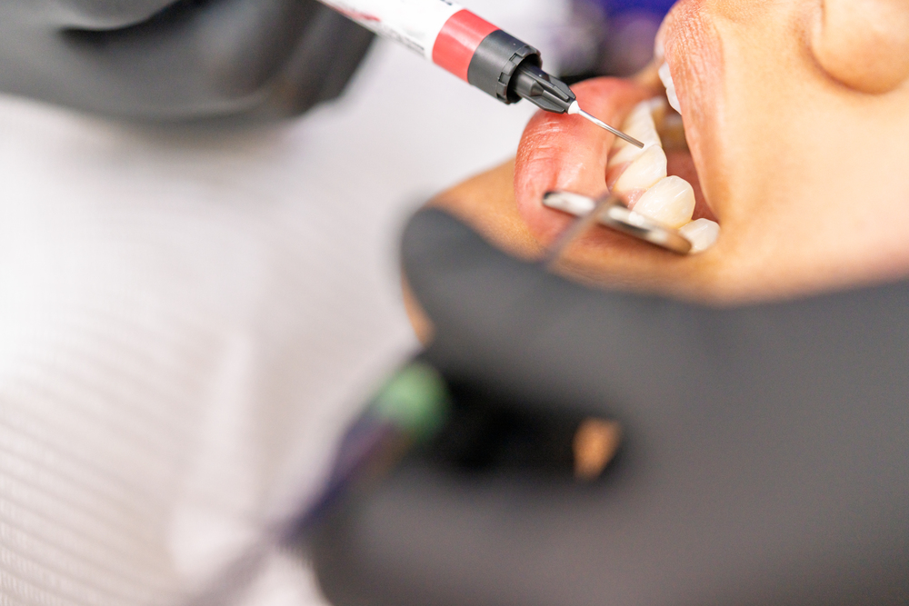 ¿Qué son los rellenos dentales