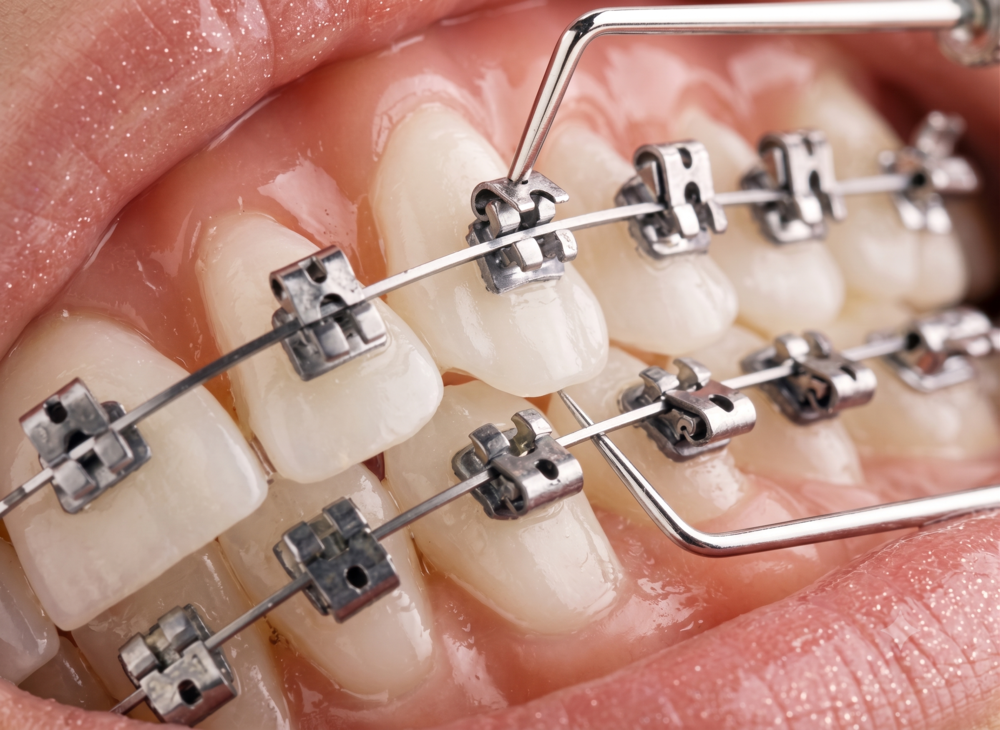 Brackets de autoligado