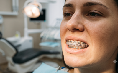 Blog De Ortodoncía En Panamá 3 Bruxismo y Ortodoncia: Cómo Rechinar los Dientes Puede Complicar tu Tratamiento Dental