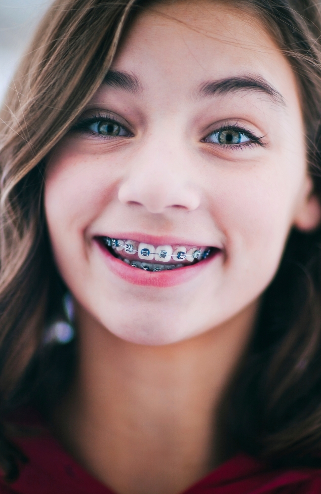 Cuánto dura el tratamiento con brackets dentales