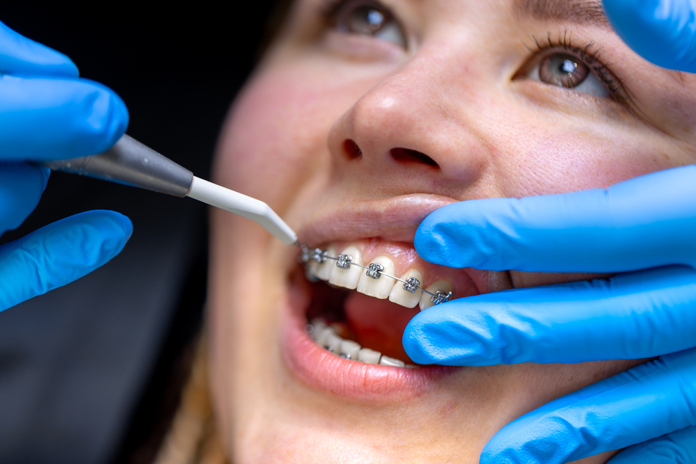 En qué consiste el tratamiento con frenos dentales