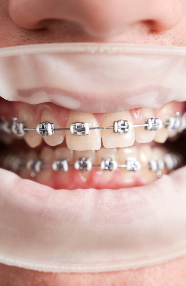 Qué tipos de frenos dentales existen dr trejos