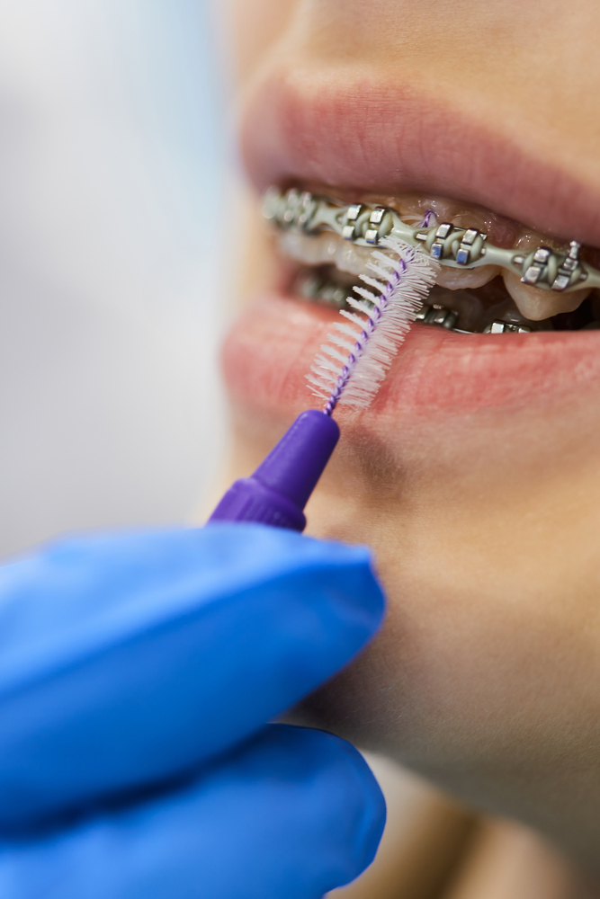 que es un freno dental