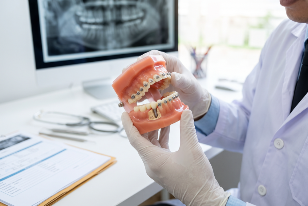 ¿Puedo Usar Brackets Si Ya Tengo Un Implante Dental? Qué Debe Evaluar El Ortodoncista 1 Por qué un implante no se mueve como un diente natural